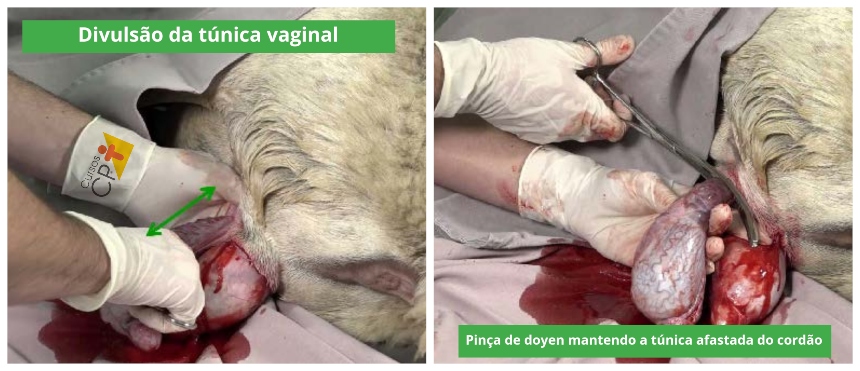 Divulsão da túnica vaginal e utilização da pinça de doyen para manter a túnica afastada do cordão Divulsão da túnica vaginal e utilização da pinça de doyen para manter a túnica afastada do cordão