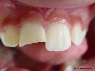 O socorrista deverá examinar a boca do acidentado procurando por pedaços de dentes, dentaduras e outros primeiros socorros